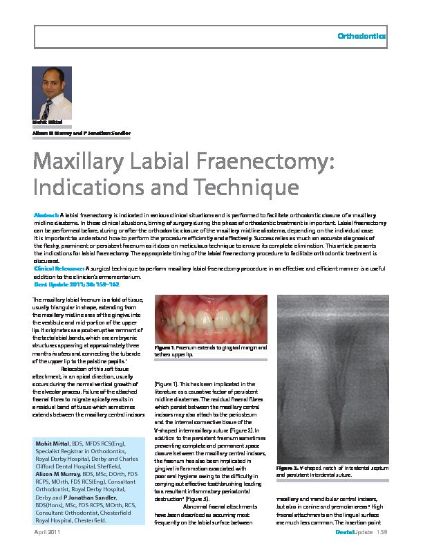 [PDF] Maxillary Labial Fraenectomy: Indications and Technique