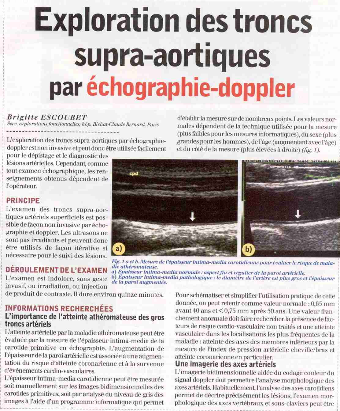 [PDF] Exploration des troncs supra-aortiques par échographie-doppler