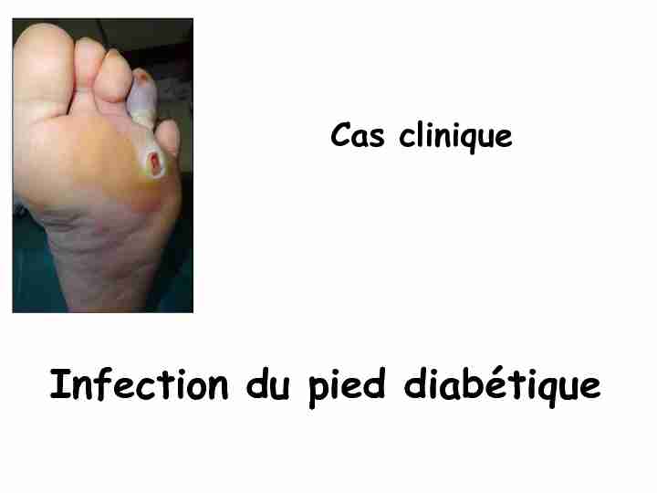 Cas clinique - Infection du pied diabétique