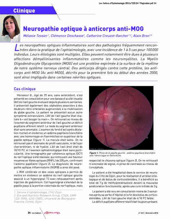 Neuropathie optique à anticorps anti-MOG
