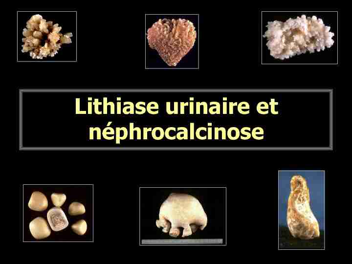 Lithiase urinaire et néphrocalcinose
