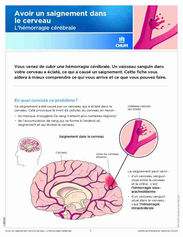 Avoir un saignement dans le cerveau - Lhémorragie cérébrale