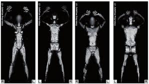 Scanners corporels à rayons X en France