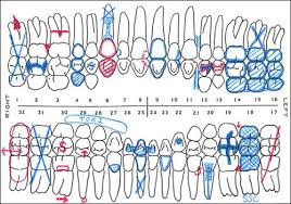 Tooth #1 is missing (charted in blue) with retained root tip (charted in