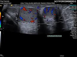 Presentation-echographie-testiculaire-JVial.pdf