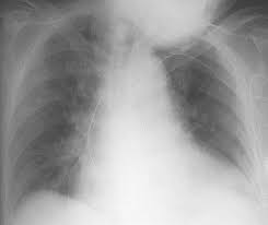 Principes de lecture de la radiographie du thorax