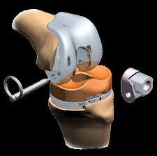 Revision Knee Arthroplasty Surgical Technique LEGION™ HK