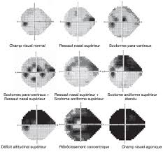 Étude comparative du champ visuel automatisé (Humphrey) et