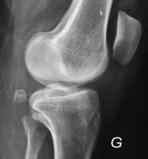 Lésions ligamentaires récentes du genou de ladulte