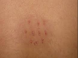 Cupping (Hijama) in Skin diseases with positive Koebners