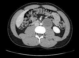 Item-313-Tumeur-testicule.pdf