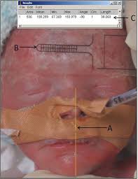 Measurements from preterm infants to guide face mask size